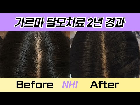 가르마 탈모치료 2년 전후, 엑스톡스(보톡스,엑소좀)ㅣ뉴헤어ㅣHair loss treatment results after 24 months