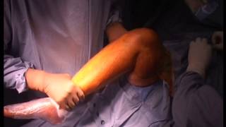 preview picture of video 'Total Knee Replacement Live from Kanpur to Chennai 1 Dr A S Prasad'