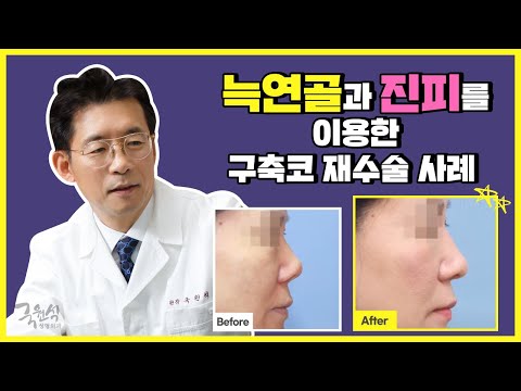 국원석성형외과 구축코 재수술 사례(Build nose Reoperation Case)