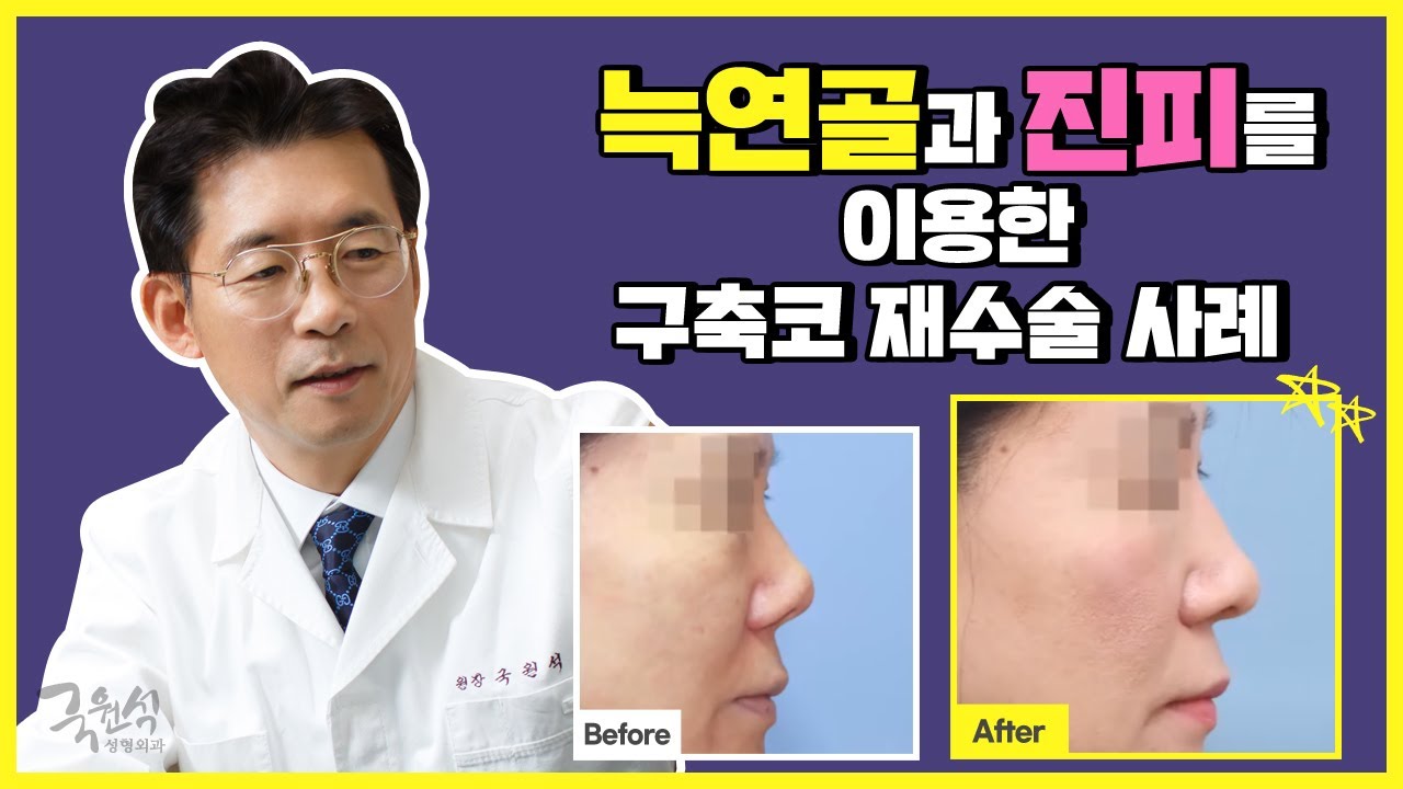 국원석성형외과 구축코 재수술 사례(Build nose Reoperation Case) 썸네일