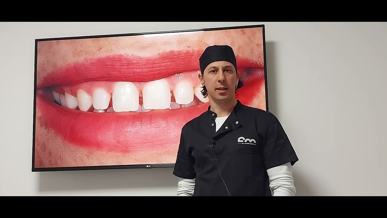 Sbiancamento dentale a Brescia