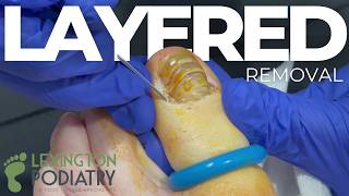 Layered Rock Nail Removal