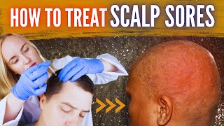 How To Treat Scalp Sores.