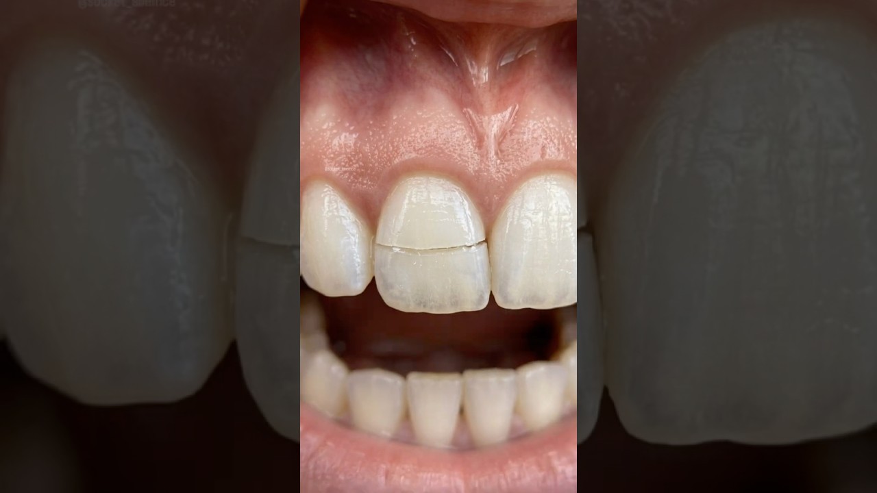 Saving a Broken Tooth: The Fiber Post Protocol 🛠️🦷