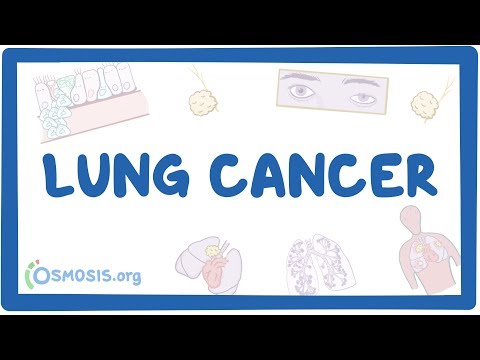 Lung cancer – causes, symptoms, diagnosis, treatment, pathology