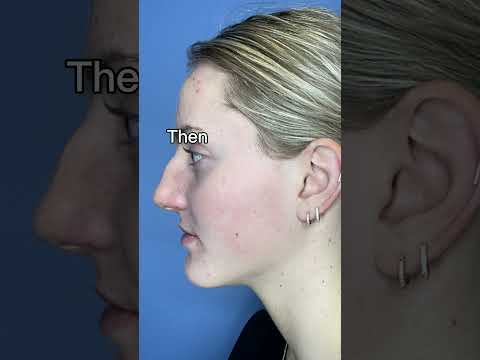 From Bump to Button Nose