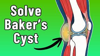 What to do about a Baker’s Cyst (Physio guide 55+)