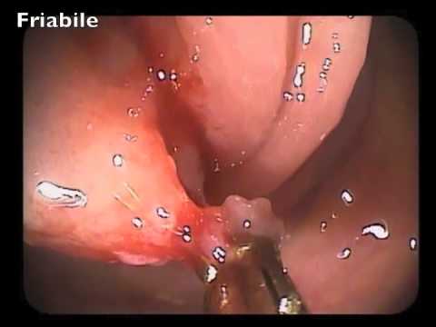 Friability - A Sign of Submucosal Invasion