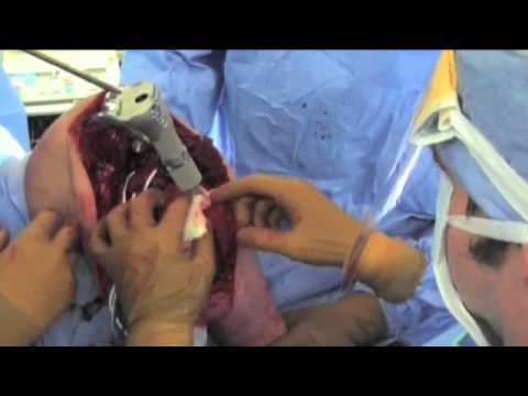 Limb-Salvage Surgery With Prosthesis Implantation And Soft Tissue Correction
