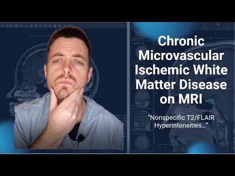 Chronic Microvascular Ischemic White Matter Disease of the Brain on MRI