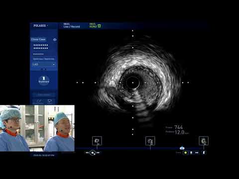 [TCTAP 2018] Coronary Symposium - Live Case & Lecture Session I