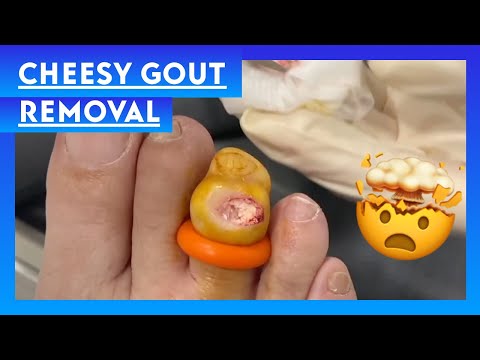 Impressive Cheesy Gout Removal || Cheesy Gout Removal