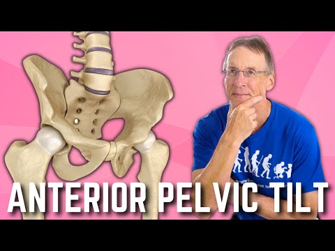 Anterior Pelvic Tilt Do You Have It  How to Fix A  BIG SURPRISE!