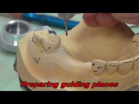 1 Rest Seat Preparation For Partial Denture Construction Dr - 