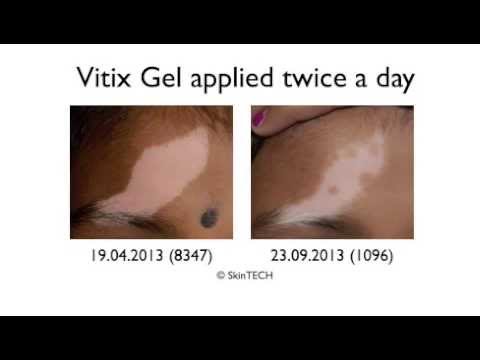 Vitix Gel