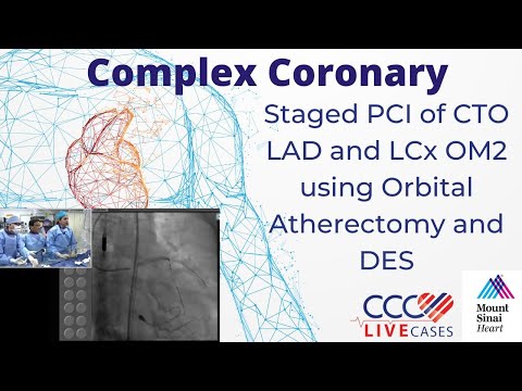 Staged PCI of CTO LAD and LCx OM2 using Orbital Atherectomy and DES - CCC Live June 2017