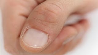 how to get rid of peeling skin around nails