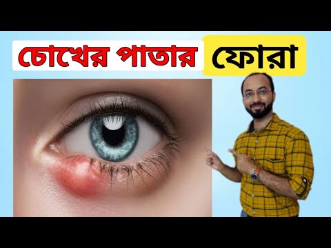 চোখে অঞ্জনি হলে করনীয় | Chalazion Treatment |চোখের পাতা ফুলে গেলে করনীয় |ক্যলজিয়ান |আঞ্জনি |anjoni