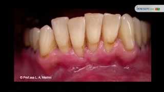 Erosione dentale: le cause, la prevenzione e gli interventi per ridurre i danni