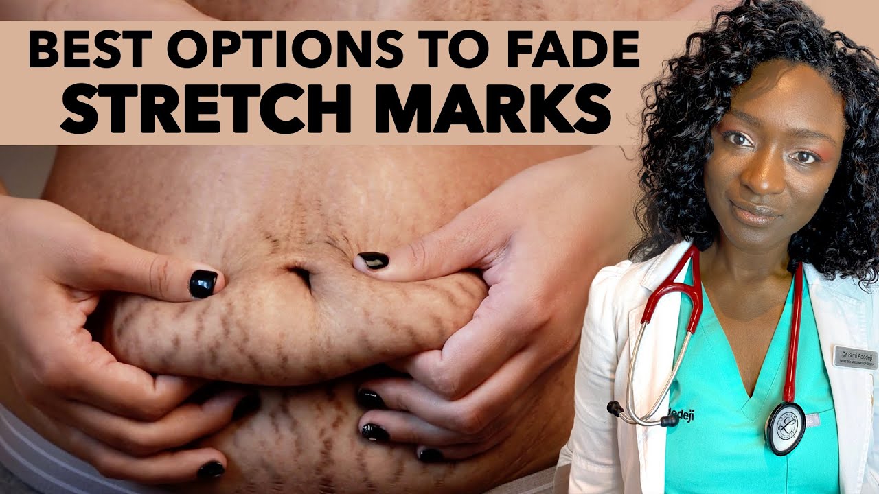 How to Fade Stretch Marks | Causes & Treatments + Best Products to Get Rid Of Stretch Marks