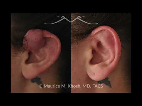 NYC Keloid Scar Removal | UES Keloid Scars Treatment | Dr. Maurice Khosh Facial Plastic Surgeon