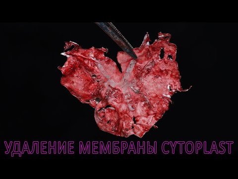 Раскрытие после костной пластики нижней челюсти, удаление мембраны Cytoplast, имплантация Straumann