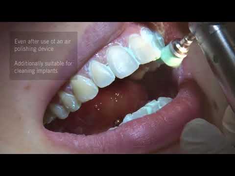 Cleanjoy fluoride containing tooth cleaning and polishing pa...