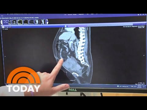 Ovarian Cancer: Warning Signs You Should Notice