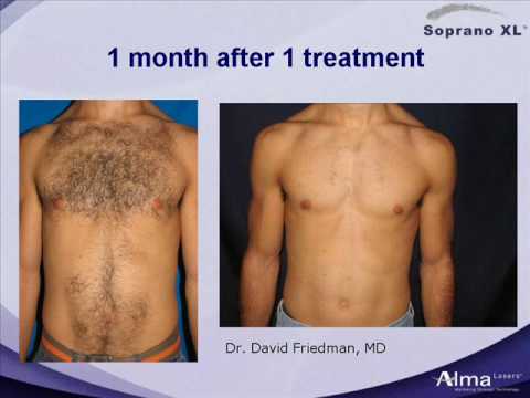 Laser Hair Removal for Men - Harpenden & St Albans