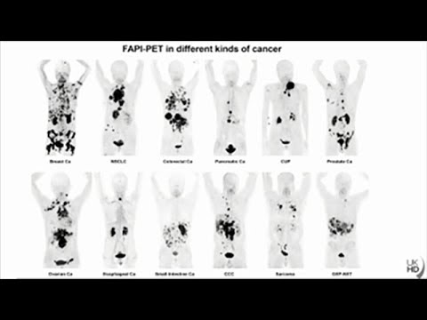 Intraductal papillomas and cancer risk