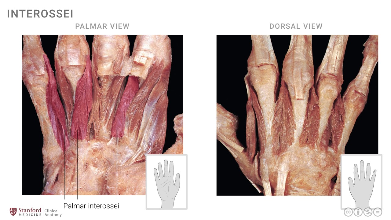 Anatomy of the Upper Limb: Interossei and Lumbricals