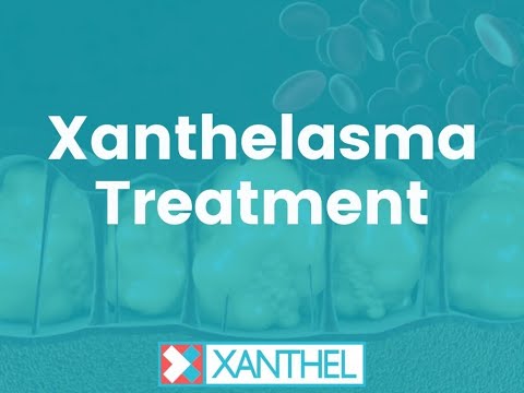 Xanthelasma Treatment