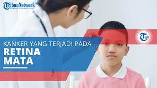 Retinoblastoma, Kanker Mata yang Tumbuh di Retina, Lapisan Sensitif di Bagian Dalam Mata