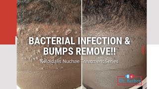 Bacteria & Bumps Removed!!