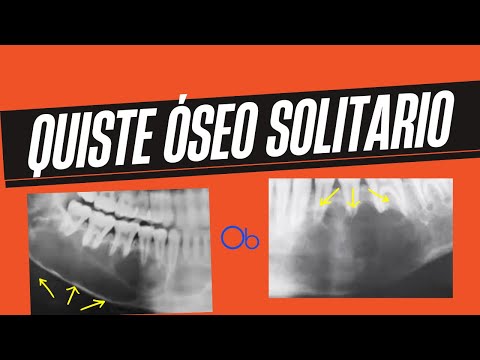 Quiste óseo solitario
