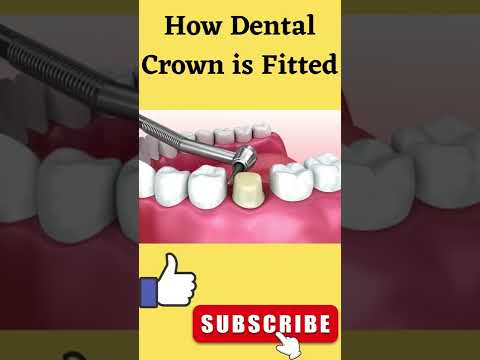 दांत पर कैप कैसे लगाई जाती है? | How Dental Crown is Fitted #Shorts