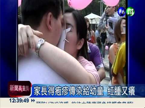 家長要當心!親吻幼童恐傳染疱疹