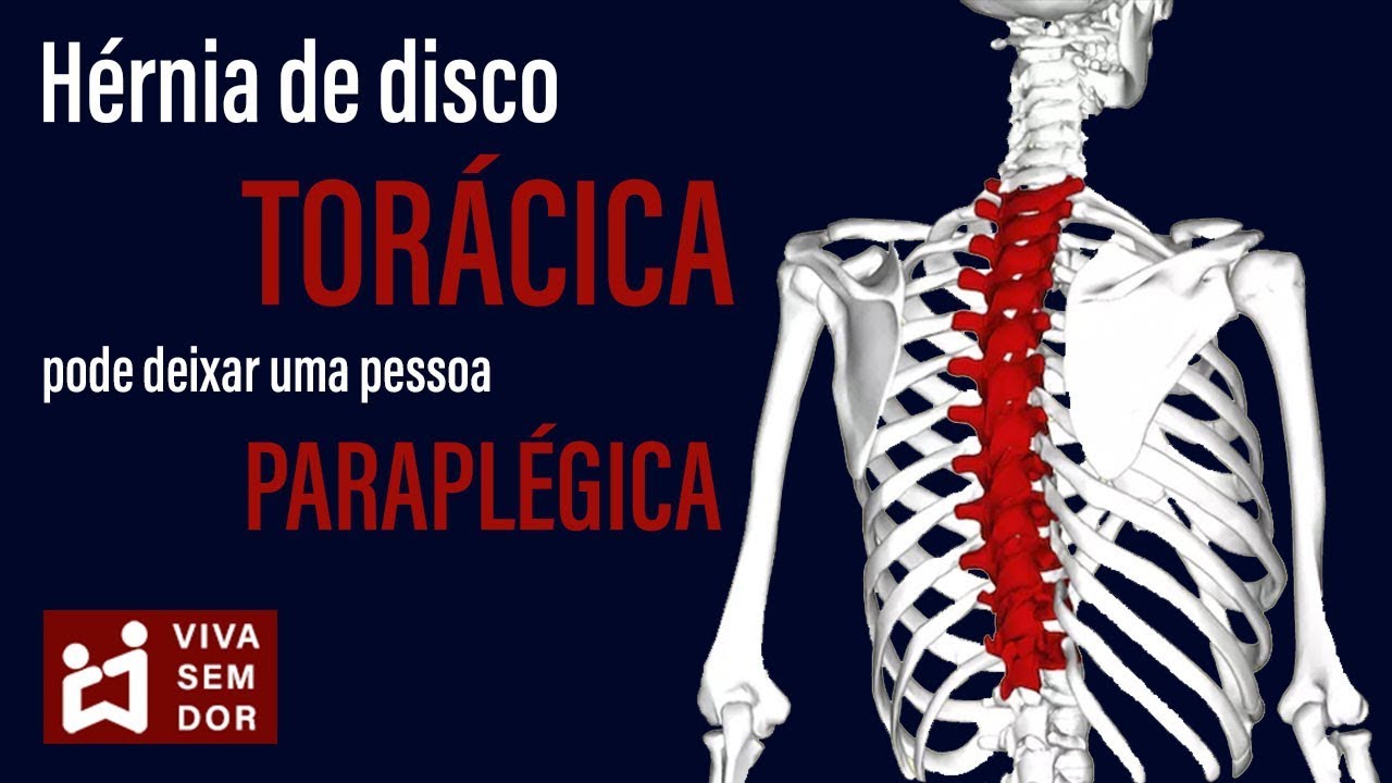 Hérnia de disco torácica pode deixar uma pessoa paraplégica