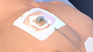 Product video: 3M Tegaderm 1665 CHG IV Port Dressing - 4.75x4.75 In