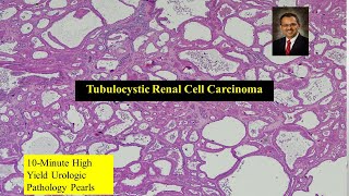 Download Lagu Tubulocystic Renal Cell Carcinoma Thumbnail