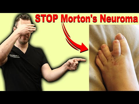, title : 'CURE Morton's Neuroma, Metatarsalgia & Ball of the Foot Pain FAST!'