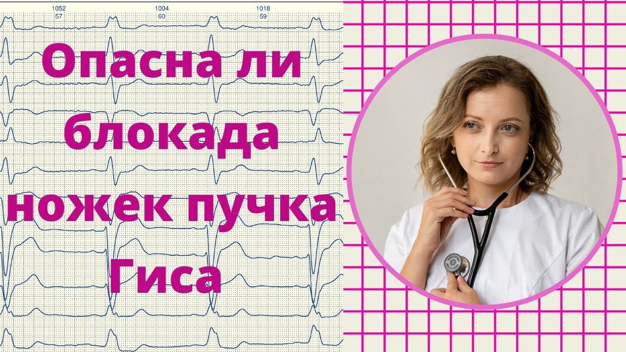 Опасна ли блокада ножек пучка Гиса.