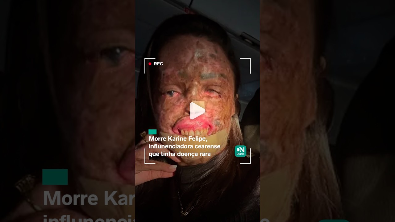 Imagem da notícia Quem era Káh Felipe, influencer cearense com doença rara que morreu aos 31 anos