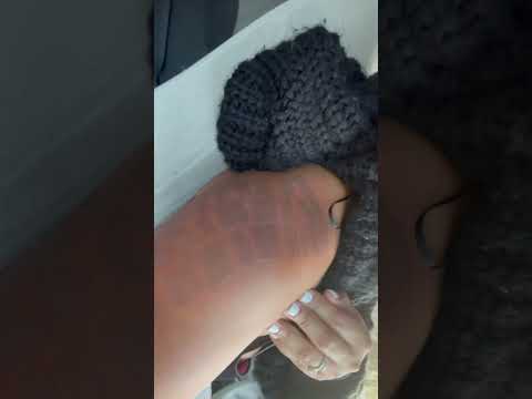 2nd degree burns after IPL #esthetician #skincare #dermatology #storytime #viralshorts