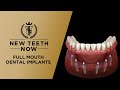 Full Mouth Dental Implant Procedure