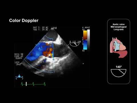 Assessing the aortic valve using TEE (mid-esophageal long-axis view)