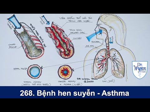 Bệnh hen suyễn (Asthma) và cách chữa trị