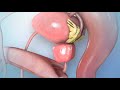 Enlarged Prostate Gland or Benign Prostatic Hyperplasia (BPH)
