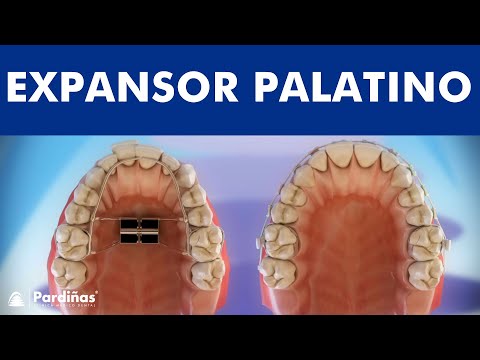 Ortodontia - Expansor Palatino e Aparelho Extra Bucal ©