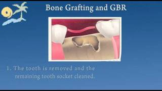 STRENGTHEN YOUR BONES Bone Grafting Long Island